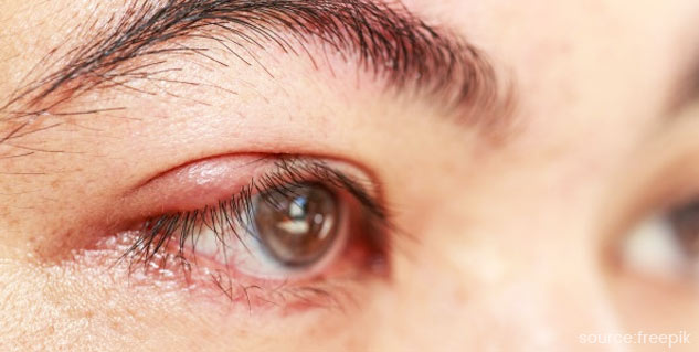 Stay Safe From These 4 Common Eye Problems During Monsoon | OnlyMyHealth