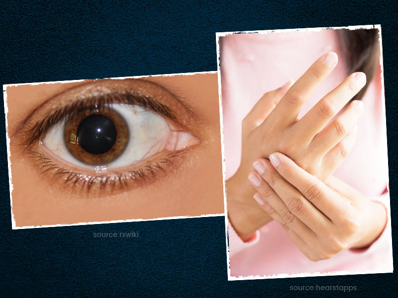 आंखों को कैसे प्रभावित करता है अर्थराइटिस? जानें एक्सपर्ट से