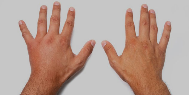 swollen_hand_inside