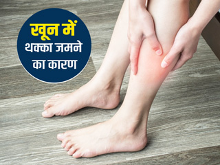 क्या है ब्लड क्लॉटिंग (खून में थक्का जमना) ? जानें इसके कारण, लक्षण और रोकथाम के उपाय