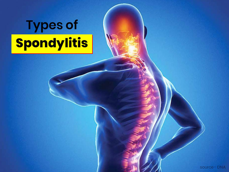 What Are The Different Types of Spondylitis? Learn About 3 Major Types In This Article