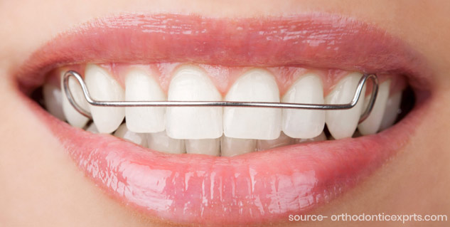 Use Retainers to Reduce or Fill Teeth Gap at Home