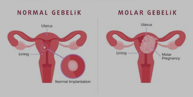 Molar Pregnancy
