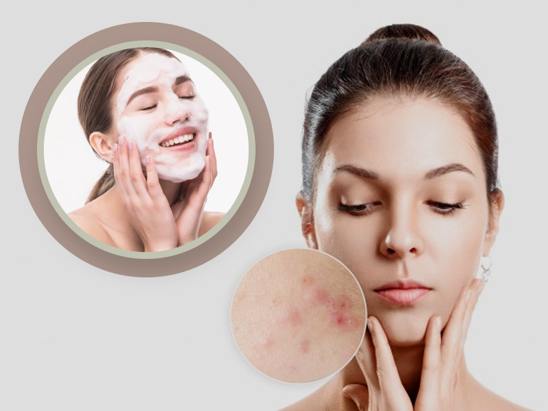 Why Are Salicylic Acid Cleansers So Popular For Acne-Prone Skin?