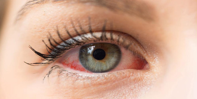Conjunctivitis  in Monsoon