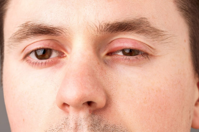 Swollen eyes - Reason and how to prevent them