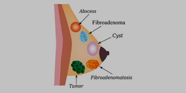 Breast Abscess: Causes, Prevention, and Treatment - Ezra