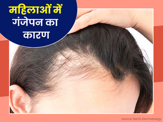 महिलाओं में बाल तेजी से बाल झड़ने का कारण हो सकता है 'फीमेल पैटर्न बाल्डनेस', जानें इसके कारण और उपचार