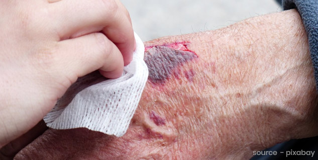 wounds