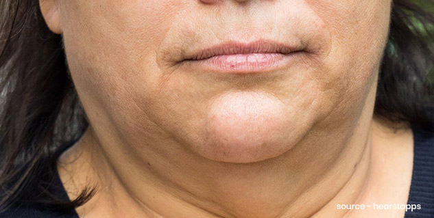 face fat