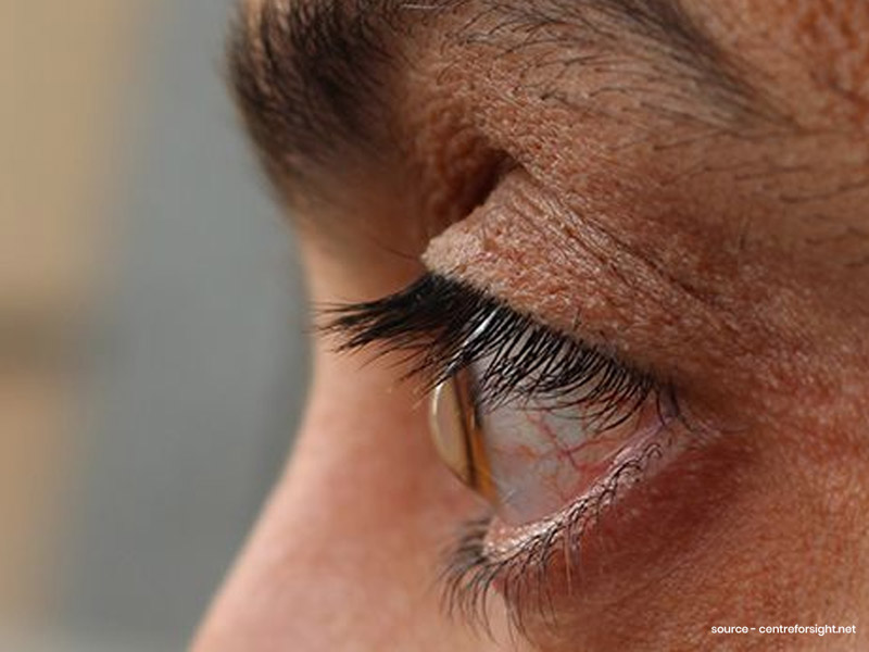 आंख की बीमारी ‘केराटोकोनस’ क्या है?  डॉक्टर से जानें क्या होते हैं इसके शुरुआती लक्षण