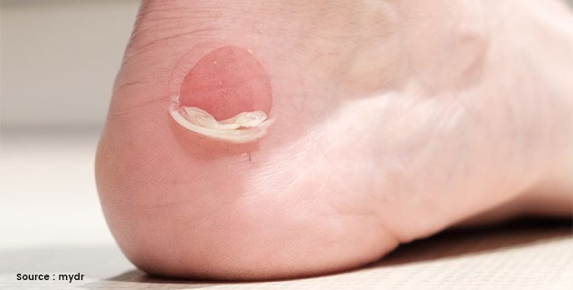 blister in leg