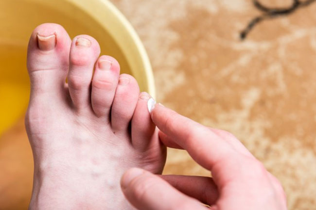 9 Home Remedies To Treat Foot Blisters At Home 6796