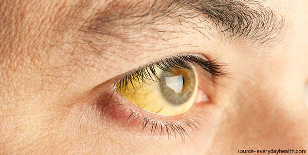 Hepatitis C  Symptoms