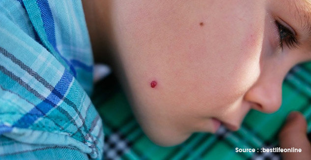 skin cancer symptoms