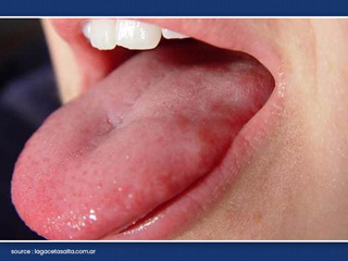 जीभ में सूजन (Glossitis) किन कारणों से आती है? डॉक्टर से जानें लक्षण और बचाव के टिप्स