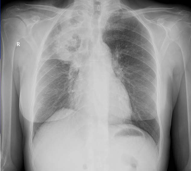 inside3_aspergillosis
