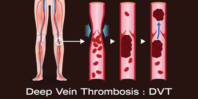 What Is Deep Vein Thrombosis (DVT)? Here Are Its Symptoms, Causes