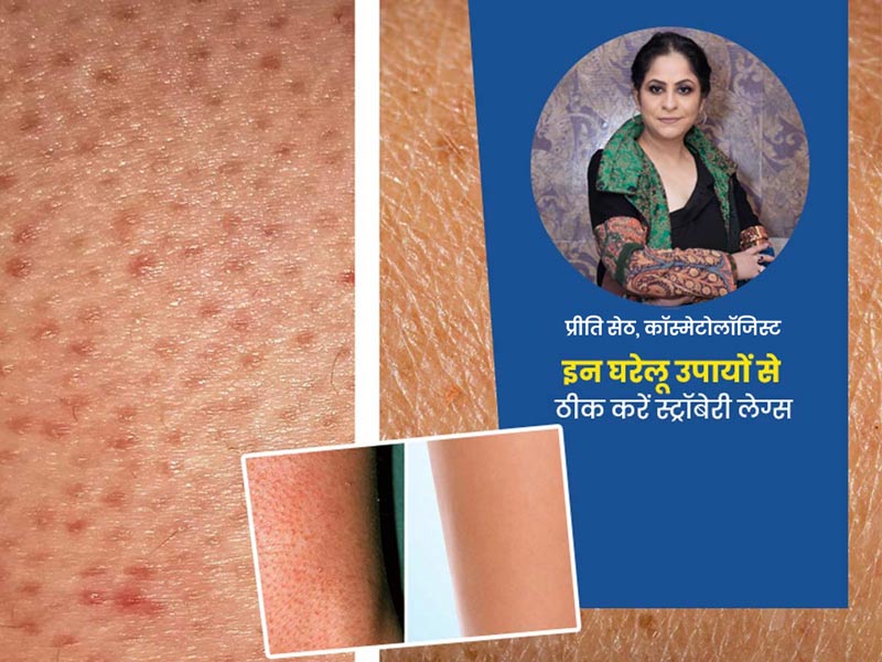 पैरों में शेविंग के बाद ब्लैक स्पॉट्स (स्ट्रॉबेरी लेग्स) से छुटकारा पाने के लिए घरेलू उपाय 