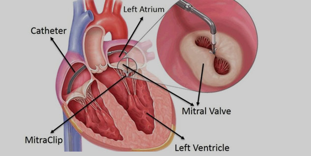 Inside4_valvereplacementsurgery