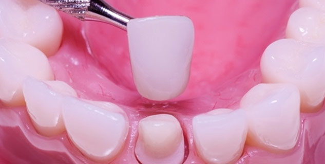 What To Do When Your Tooth Crown Falls Out?