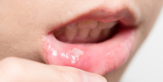 oral-cancer