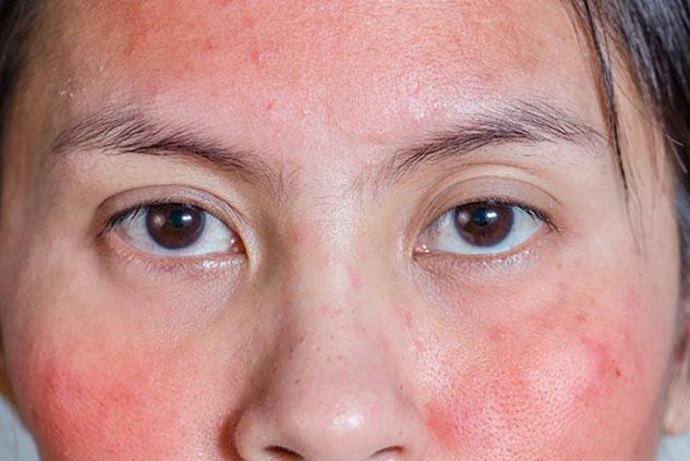 redness-home-remedies-to-cure