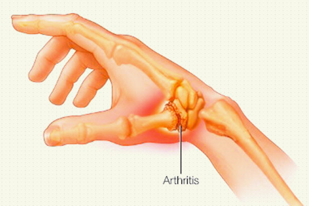 thumb arthiritis