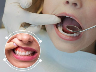 मुंह के कैंसर (Oral Cancer) से जुड़े 12 पॉपुलर मिथक और उनकी सच्चाई बता रहे हैं एक्सपर्ट