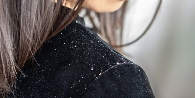 Wet Dandruff: Know Causes and Home Remedies for Wet Dandruff | OnlyMyHealth