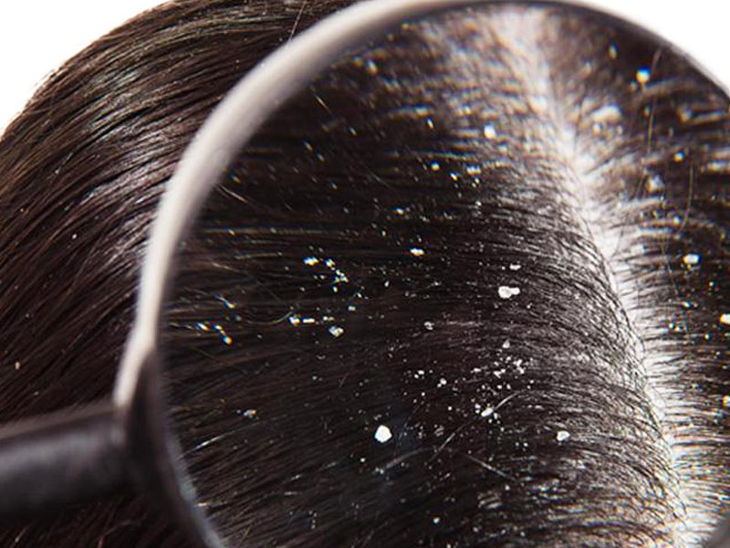 Wet Dandruff: Know Causes and Home Remedies for Wet Dandruff