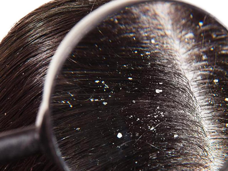 Wet Dandruff: Know Causes and Home Remedies for Wet Dandruff | OnlyMyHealth