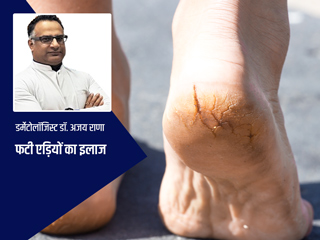 हर मौसम में फटी रहती हैं आपकी एड़ियां? शरीर में हो सकती है इन 3 विटामिन की कमी