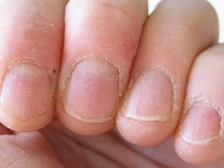 नाखूनों के आसपास की स्किन (cuticles) खराब हो तो अपनाएं घरेलू उपाय