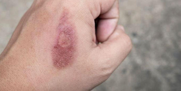 skin burn treatment