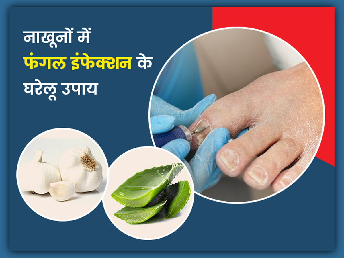 home remedies to get rid of nail infection in hindi। नाखूनों में फंगल  इंफेक्‍शन के घरेलू उपाय