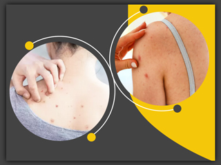 पीठ पर मुंहासे (दाने) क्यों होते हैं? घर पर मौजूद इन चीजों पाएं Back Acne से  जल्द राहत