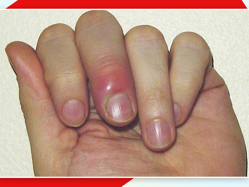 Nail Infection Paronychia Symptoms Treatment | नाखून के आसपास त्वचा में  इंफेक्शन का कारण हो सकता है पैरोनिकिया, जानें इसके लक्षण और बचाव के उपाय