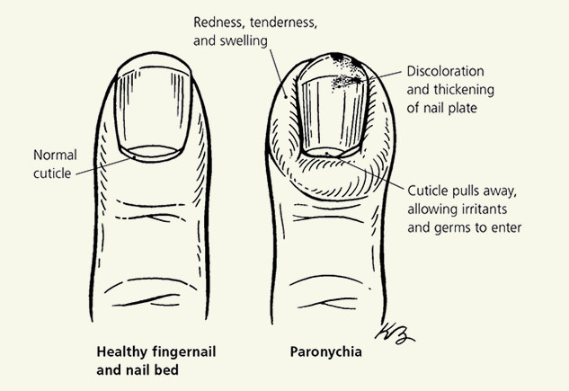 White Spots On Nails: आपके नाखूनों पर भी है सफेद निशान? शरीर में इन  दिक्कतों का है संकेत - White spots on nails Causes prevention and treatment  and how to avoid them