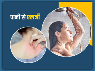 पानी से भी हो सकती है आपको एलर्जी, जानें Water Allergy का कारण और लक्षण 