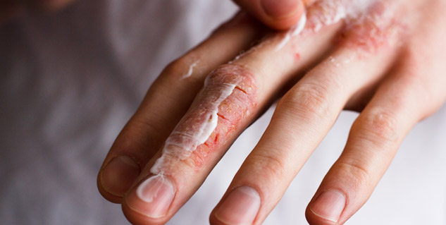 Skin peeling deals on hands