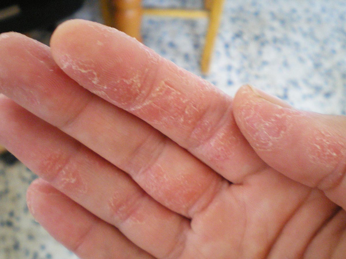 why is my skin peeling on my hands , why is my cum thick