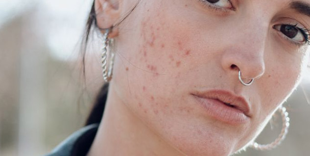fitkari to remove acne scar