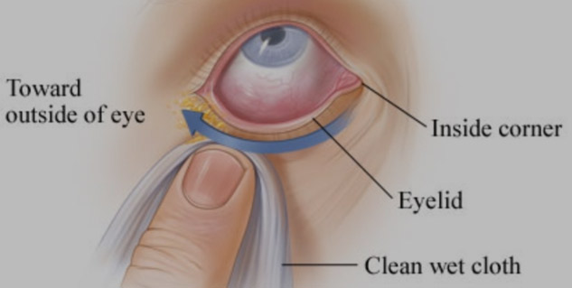 how to clean eyes