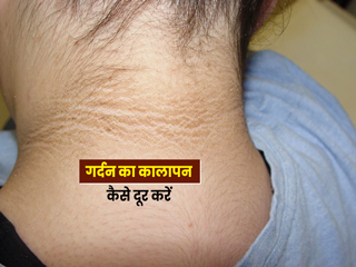 इन 3 कारणों से लोगों की गर्दन होने लगती है काली, जानें काली गर्दन को साफ करने के घरेलू उपाय