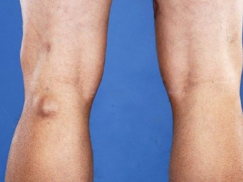 घुटने के पिछले हिस्से में गांठ (बेकर्स सिस्ट) होने पर इन 5 आयुर्वेदिक नुस्खों से करें इलाज