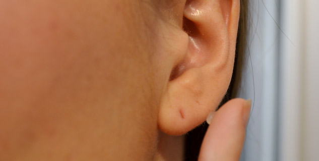 What Does An Infected Ear Piercing Look Like? | Ear Piercing Infection:  Identification & Treatment