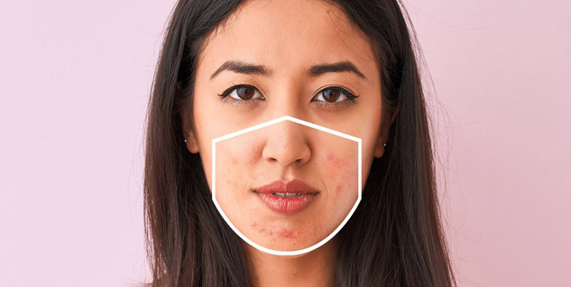 Mask Acne or Maskne
