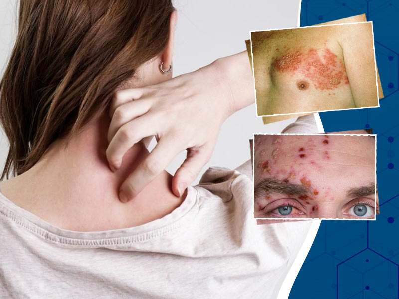 Shingles Symptoms, Causes and Complications