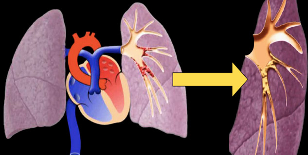 Do You Experience Breathing Issues When Lying Down? It Could Be Orthopnea